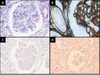 Membranous Nephropathy Secondary to Graves’ Disease: A Case Report